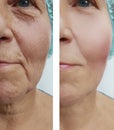 Elderly woman wrinkles on face medical lifting regeneration before after Royalty Free Stock Photo