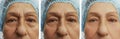Elderly woman wrinkles on face medical patient health removal lifting regeneration before after Royalty Free Stock Photo