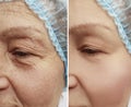 Elderly woman wrinkles on face medical health removal lifting regeneration before after Royalty Free Stock Photo