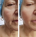 Elderly woman wrinkles on face medical removal lifting regeneration before after Royalty Free Stock Photo