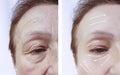 Elderly woman wrinkles on face medicine hydrating results cosmetology before and after procedures Royalty Free Stock Photo