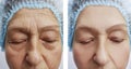 Elderly woman wrinkles removal dermatology face before and after procedures, effect Royalty Free Stock Photo