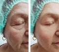 Elderly woman wrinkles removal dermatology correction face before and after procedures, effect Royalty Free Stock Photo