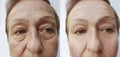 Elderly woman wrinkles on face before and after procedures Royalty Free Stock Photo