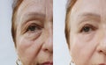 Elderly woman wrinkles face before and after removal dermatology lifting aging procedures Royalty Free Stock Photo