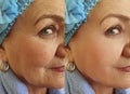 Elderly woman wrinkles face correction hydrating effect regeneration treatment before and after treatment Royalty Free Stock Photo