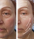 Elderly Woman wrinkles before after medicine contour tension hydrating the procedure effect regeneration