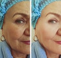 Elderly woman wrinkles removal face correction therapy hydrating effect regeneration treatment before and after treatment Royalty Free Stock Photo