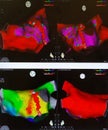 Electrical Mapping of the Left Atrium - Radiofrequency Ablation for SVT Royalty Free Stock Photo