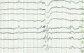 Electro-encephalogramme