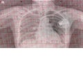 Electrocardigram of wave in paper report