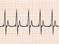 Electrocardiogram