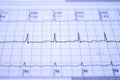 Electrocardiogram with cardiac arrhythmia. Atrial fibrillation recorded as the origin of many cerebrovascular accidents or strokes