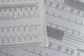 Electrocardiogram with cardiac arrhythmia. Patient with atrial fibrillation and atrial flutter Royalty Free Stock Photo