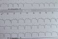 Electrocardiogram with cardiac arrhythmia. Patient with cardiac pacemaker