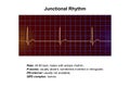 Electrocardiogram displaying a junctional rhythm, 3D illustration