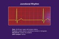 Electrocardiogram displaying a junctional rhythm, 3D illustration