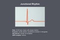 Electrocardiogram displaying a junctional rhythm, 3D illustration