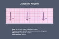 Electrocardiogram displaying a junctional rhythm, 3D illustration