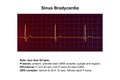 Electrocardiogram displaying sinus bradycardia, 3D illustration Royalty Free Stock Photo