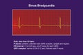 Electrocardiogram displaying sinus bradycardia, 3D illustration