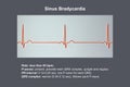 Electrocardiogram displaying sinus bradycardia, 3D illustration