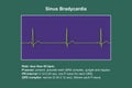 Electrocardiogram displaying sinus bradycardia, 3D illustration