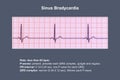 Electrocardiogram displaying sinus bradycardia, 3D illustration