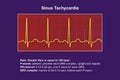 Electrocardiogram displaying sinus tachycardia, 3D illustration