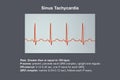 Electrocardiogram displaying sinus tachycardia, 3D illustration