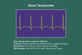 Electrocardiogram displaying sinus tachycardia, 3D illustration