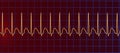 Electrocardiogram displaying supraventricular tachycardia, 3D illustration