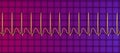 Electrocardiogram displaying supraventricular tachycardia, 3D illustration