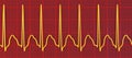 Electrocardiogram displaying supraventricular tachycardia, 3D illustration