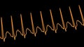 Electrocardiogram displaying supraventricular tachycardia, 3D illustration