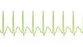 Electrocardiogram displaying supraventricular tachycardia, 3D illustration