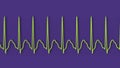 Electrocardiogram displaying supraventricular tachycardia, 3D illustration