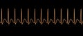 Electrocardiogram displaying supraventricular tachycardia, 3D illustration