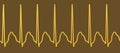 Electrocardiogram displaying supraventricular tachycardia, 3D illustration