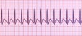 Electrocardiogram displaying supraventricular tachycardia, 3D illustration