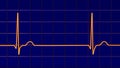 Electrocardiogram ECG displaying a junctional rhythm, 3D illustration