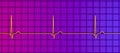 Electrocardiogram ECG displaying a junctional rhythm, 3D illustration