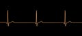 Electrocardiogram ECG displaying a junctional rhythm, 3D illustration