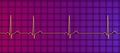 Electrocardiogram ECG displaying sinus arrhythmia, 3D illustration