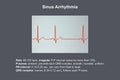 Electrocardiogram ECG displaying sinus arrhythmia, 3D illustration Royalty Free Stock Photo