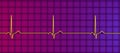 Electrocardiogram ECG displaying sinus bradycardia, 3D illustration