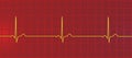 Electrocardiogram ECG displaying sinus bradycardia, 3D illustration