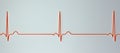 Electrocardiogram ECG displaying sinus bradycardia, 3D illustration