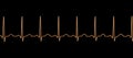 Electrocardiogram ECG displaying sinus tachycardia, 3D illustration