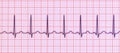 Electrocardiogram ECG displaying sinus tachycardia, 3D illustration